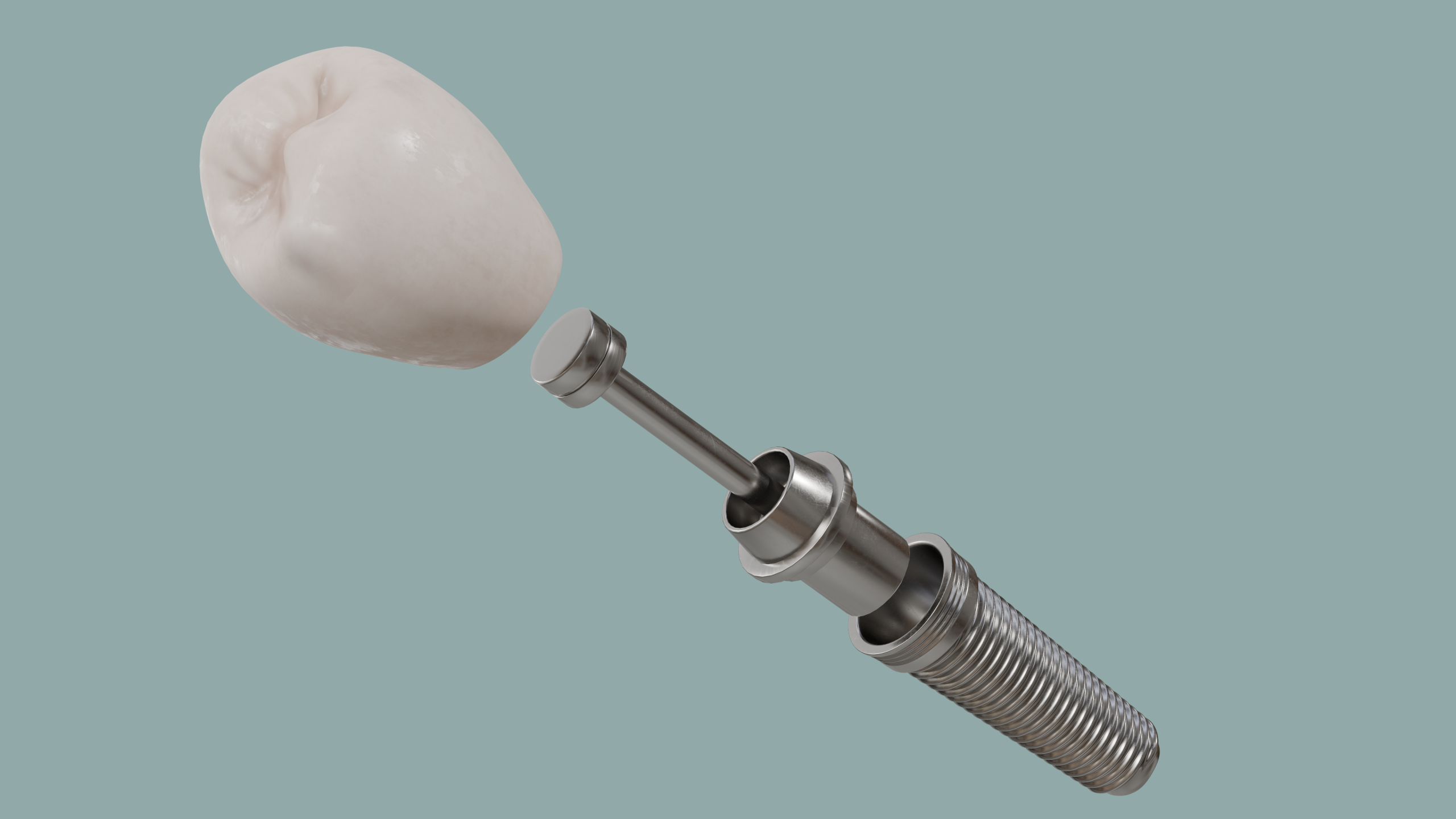 3D-Darstellung eines Zahnimplantats mit ausgeklappten Komponenten zur Visualisierung der Einzelteile