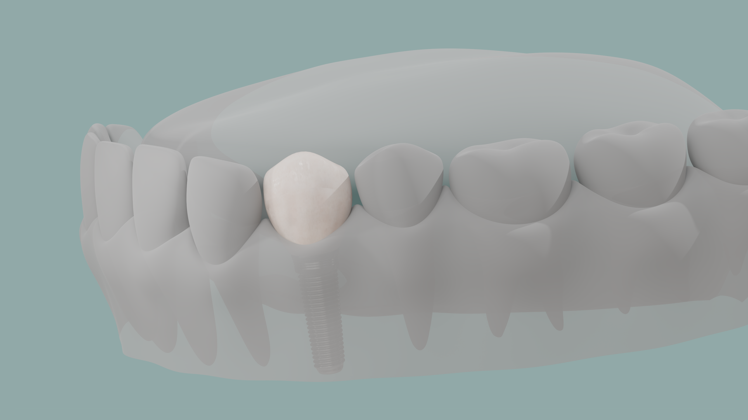 3D-Darstellung eines eingesetzten Zahnimplantats im Gebiss mit transparentem Zahnfleisch zur Visualisierung der Implantatposition